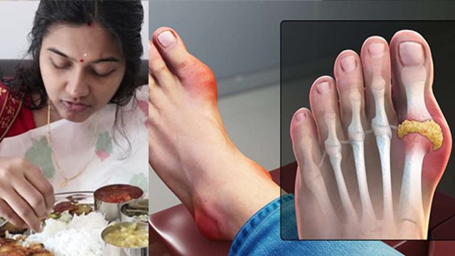 Does Rice Cause High Uric Acid, हाई यूरिक एसिड में चावल खा सकते हैं या नहीं | Boldsky