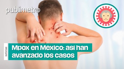 Mpox en México: así han avanzado los casos; ya hay registros en CDMX y Edomex