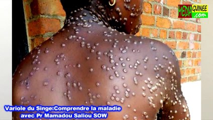Variole du singe : comprendre la maladie avec Pr Mamadou Saliou Sow