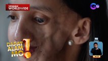 Dalagita, tampulan ng tukso noon dahil sa kanyang Parry Romberg Syndrome | Dapat Alam Mo!