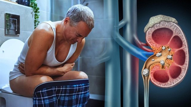 Kidney Stone Pain Relief: Fresh Hone Ke Baad Pet Me Dard Kyon Hota Hai, Pet Dard Ka Ilaj|Boldsky