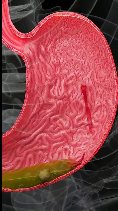 Hemorrhagic Gastric Ulcers Explained Causes of Bleeding Stomach Ulcers Gastric Ulcer Animation गैस्ट्रिक अल्सर टीकाकरण تحصين قرحة المعدة Bleeding Stomach Ulcer Animation