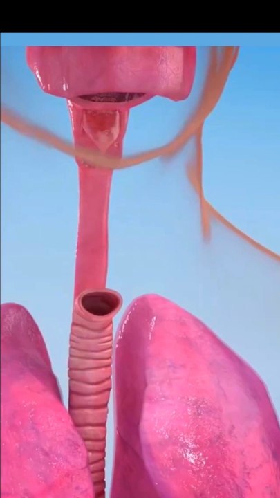 Laryngectomy Procedure Animation लेरिन्जेक्टोमी प्रक्रिया एनीमेश गले के कैंसर जागरूकता वीडियो جراحة سرطان الحنجرة