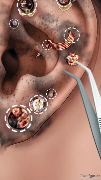 How To Clean Infected Hole EAR Piercing | Ear Cleaning Therapy asmr #earings #animation #treatment    #dailymotion