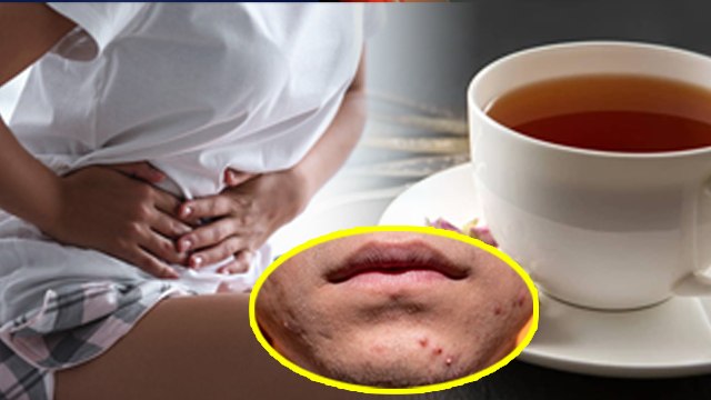 Menstrual Pimples Treatment: Periods Me Pimple Kyu Ho Jate Hai, Causes & Treament...