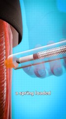 How An EpiPen Works  #fyp #reels #viralreelschallenge #viralreelsfb #trendingreelsvideo #facts #medical #injections #May #steviewonder #Indy500
