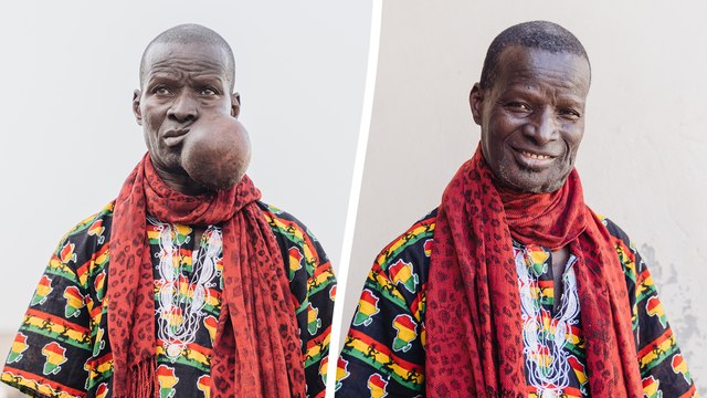 Teacher who quit job due to MELON-SIZED face tumour unrecognisable after surgery