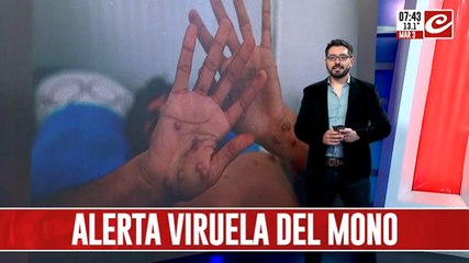Viruela del mono: cada vez son más los casos confirmados en Argentina