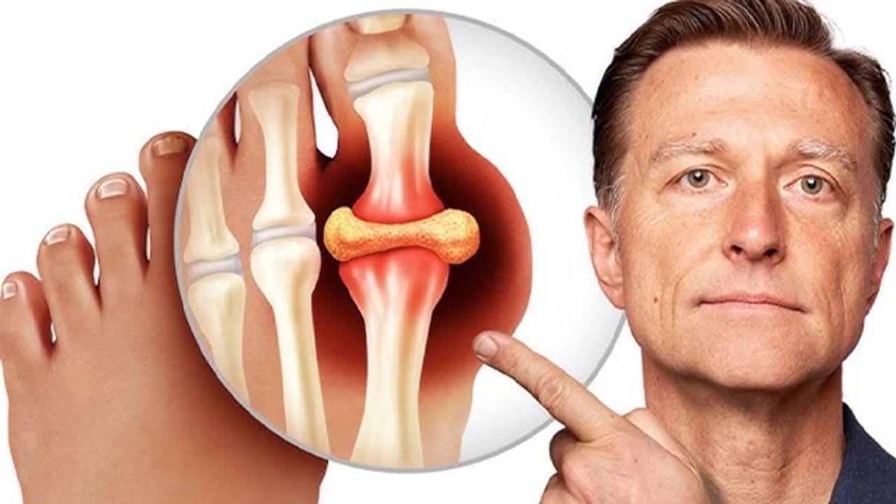 High Uric Acid से Kidney Stone Risk कैसे | Uric Acid Stones Symptoms & Treatment | Boldsky