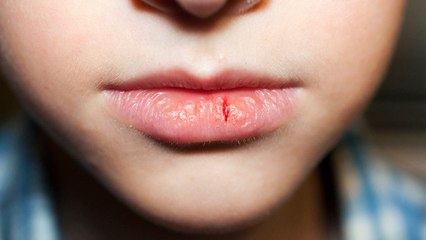 bd-labios-resecos-posibles-causas-y-tratamientos-030924