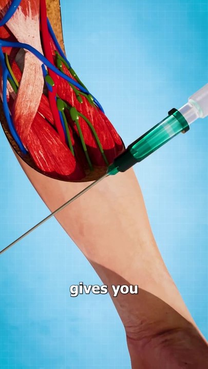 Blown Veins -- (explained)