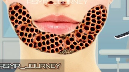 Relaxing face maggots removal animation ❤‍