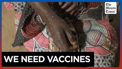 Doctor in mpox-hit DR Congo asks for vaccines 'as a matter of urgency'