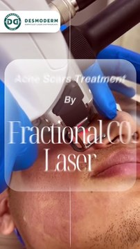Buff Away Acne Scars The Power of Fractional CO2 Laser! ✨
