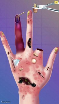 Infected Maggots Hand Removal | toe swelling ingrown toenails Cosmetic Treatment#hand#treatment#asmr