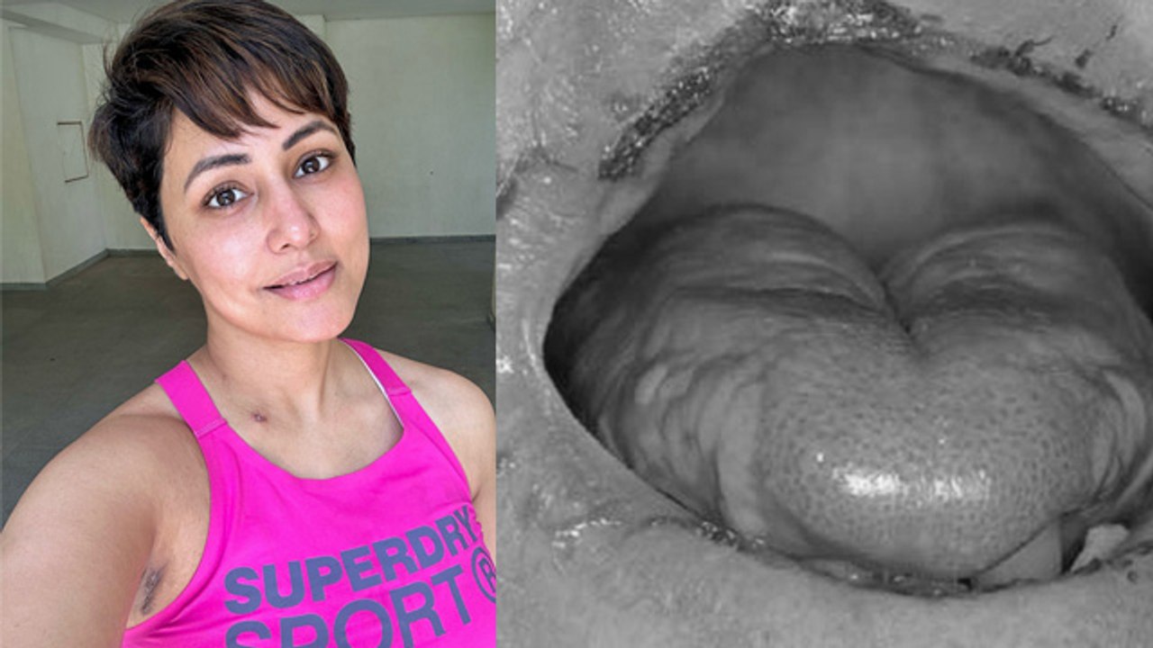 Hina Khan Breast Cancer के बाद हुआ Mucositis, Mucositis Kya Hota Hai,Symptoms & Treatment..|