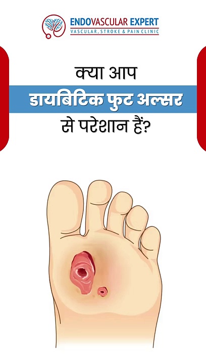 ⁣diabetic Foot Ulcer By Dr Nikhil Bansal Radiologist in jaipur