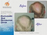 Manzanares Hair Restoration Center - Men Hair Transplant