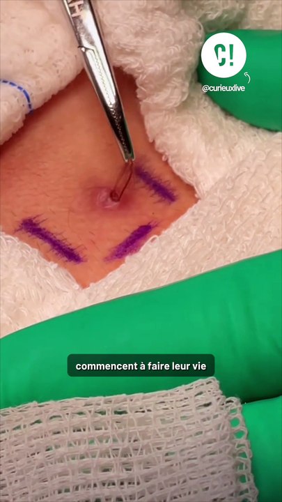 C'est quoi un kyste pilonidal ?