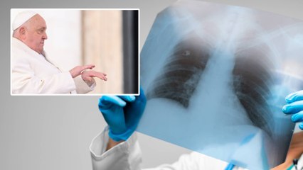 ¿Qué tan grave es la broncoaspiración que sufrió el Papa Francisco? Próximas 48 horas serán decisivas