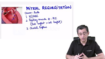 8. Mitral regurgitation