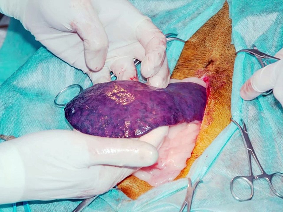 what is Splenectomy | 5 benefits and side effects of splenectomy | तिल्ली को हटाने का ऑपरेशन