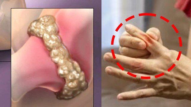 High Uric Acid Pain Areas: Uric Acid Me Kaha Kaha Dard Hota Hai, Body Symptoms...|Boldsky