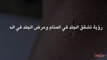 رؤية تشقق الجلد في المنام ومرض الجلد في الحلم