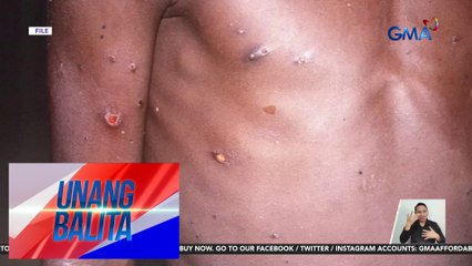 DOH, nagbabala laban sa imported mpox vaccine na umano'y ibinebenta sa bansa | Unang Balita