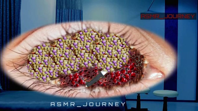 ASMR Eye Cleaning: Maggot & Dog Tick Removal Animation | Ultimate Treatment & Care