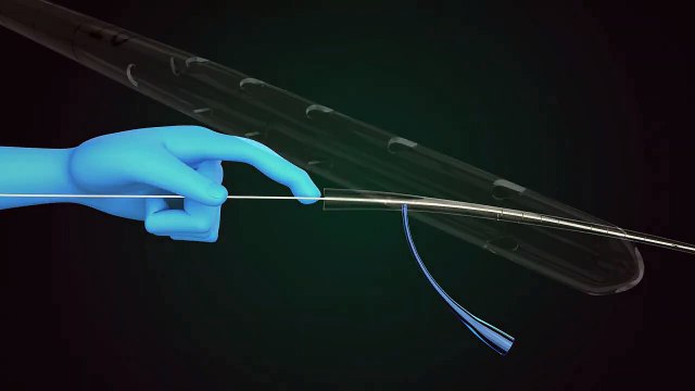 Medical Explainer Video for NG Tube by Whimsitoons | 3D Product Animation