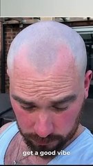Best Scalp Micropigmentation Result - SMP by Marcin Adam - MicroHair® Liverpool