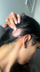 You Only Need The Dermaroller for Hair Growth