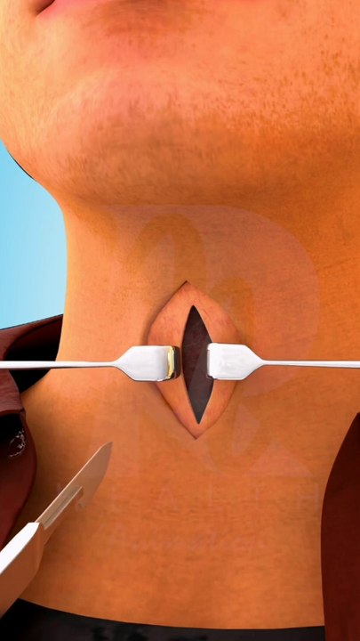 Tracheostomy Surgery Tracheostomy procedure 3D animation Tracheostomy Tube ट्रेकियोस्टोमी ट्यूब