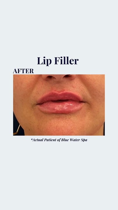 Lip Fillers - Before and After