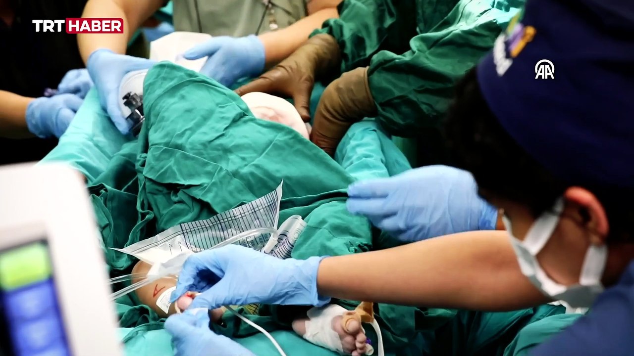 Pakistanlı siyam ikizlerine Türkiye'de umut ışığı doğdu