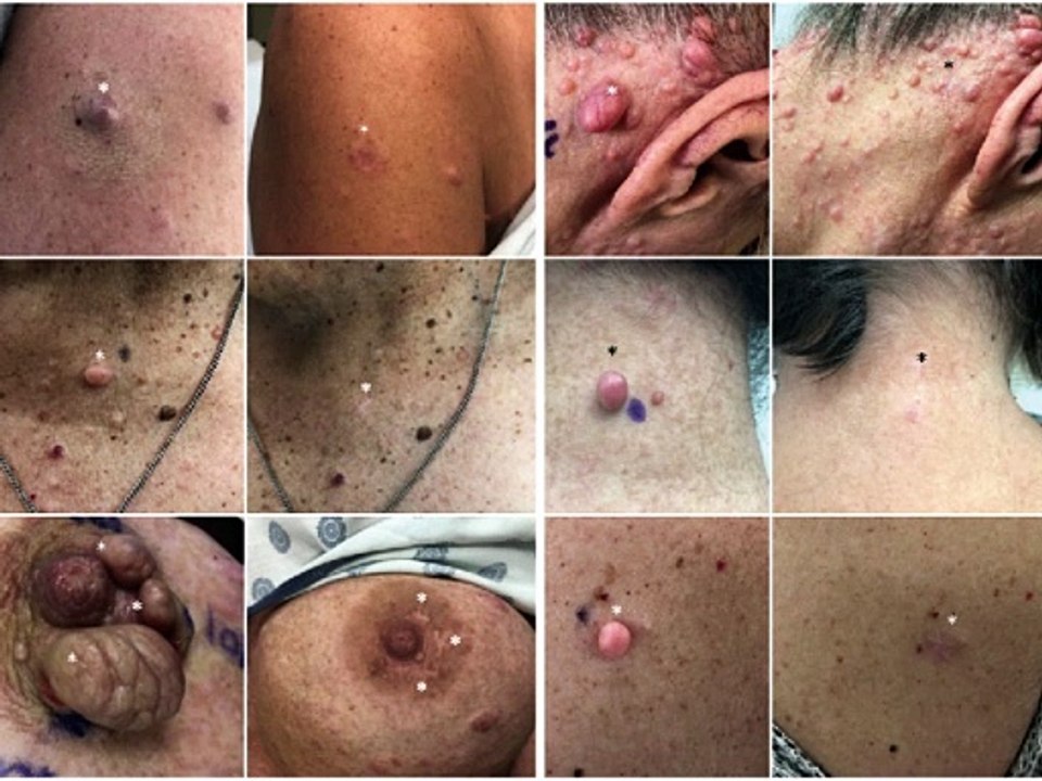Neurofibromatosis ( नसों में फोड़े ) symptoms causes diagnosis and treatment in hindi