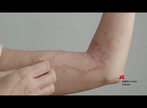 Psoriasi, via libera di Aifa a rimborsabilità deucravacitinib per forma moderata e severa