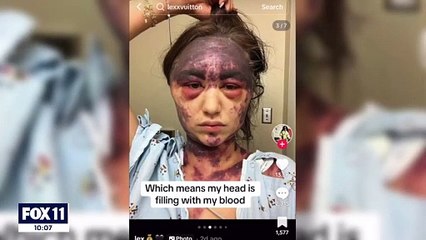 California woman, 23, turns purple after alleged vaccination at a hospital