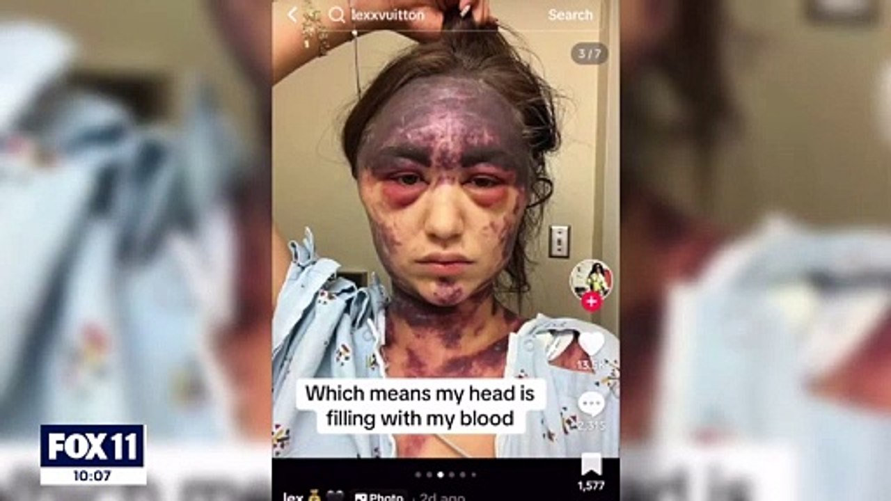 California woman, 23, turns purple after alleged vaccination at a hospital