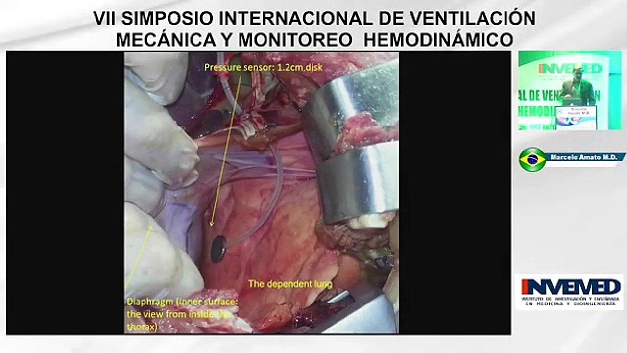 12.- Pendelluft - Significado Fisiológico - Implicancias Durante La Vni - Dr. Marcelo Amato-1.m4v_2