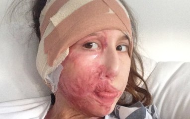 "I had 70 operations after acid attack in Zanzibar - now I'm confident in my scars"