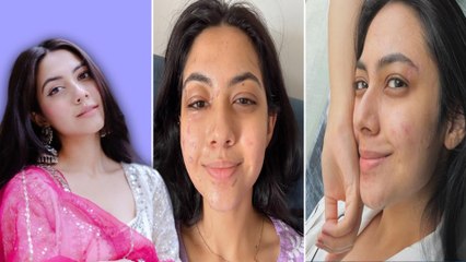 Reem Shaikh के चेहरे की इतनी बुरी हुई हालत, चोटों के निशान देख फैंस घबरा गए | FilmiBeat