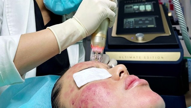 RF siêu vi điểm trị sẹo rỗ tại Phòng khám Da liễu Doctor Acnes