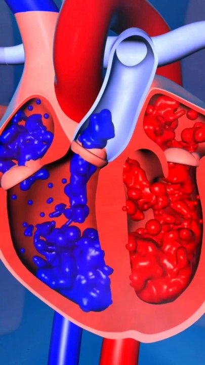 Carvia Atrial shunt device|3D Animation|#viral#shorts#3Danimation#DrSadia1446#shortsfeeds