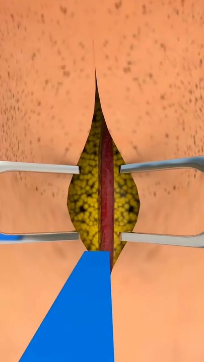 Tracheostomy Surgery Tracheostomy procedure 3D animation Tracheostomy Tube ट्रेकियोस्टोमी ट्यूब