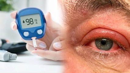 Sugar Me Ankhon Ke Upper Swelling Kyu Aati Hai | Does Diabetes Cause Swollen Eyelids Reason