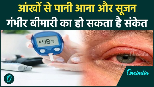 Diabetes के मरीजों में आँखों के ऊपर सूजन क्यों आती है? | Symptoms and Causes | वनइंडिया हिंदी