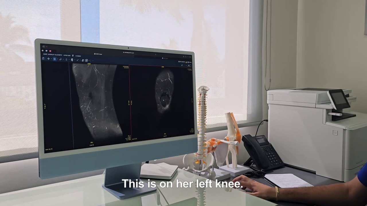 Shirleys Before and After Knee MRIs - Huge Improvement to Arthritis ACL and Meniscus from