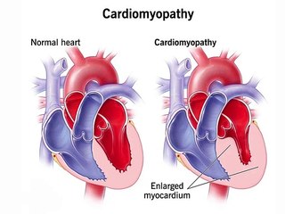 cardiomyopathy, 5 diseases of the heart muscle due to which one can die,